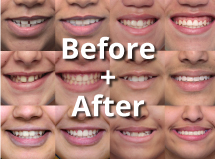 Before and after braces gallery