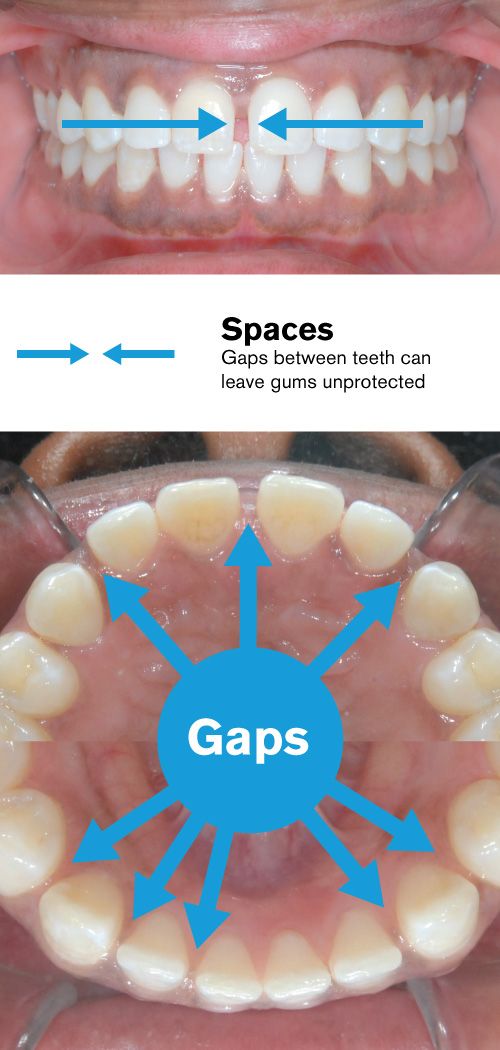 Spaces between teeth before braces