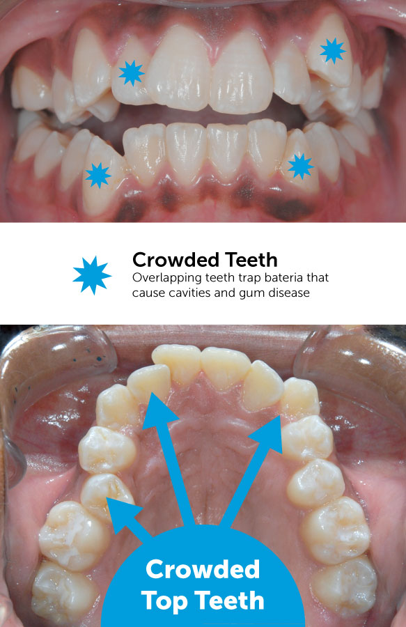 Crowded top teeth before braces