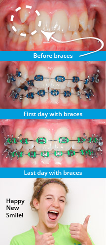 Before and After Braces at Smile Logic Orthodontics