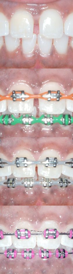 How to close spaces with braces