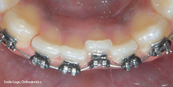 Straightening of crooked teeth during braces