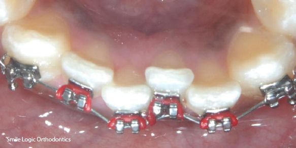 Braces used to fix crooked bottom teeth