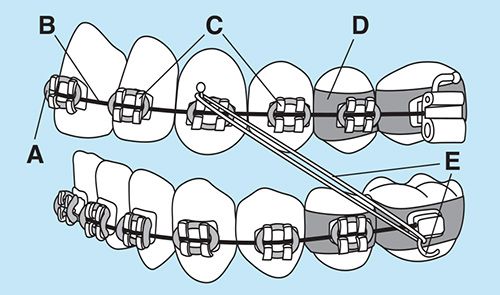 Parts of braces at Smile Logic Orthodontics