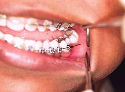 Fix braces poking wire