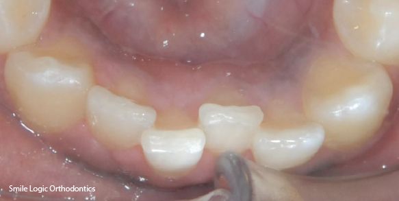 Before and after braces fix crooked bottom teeth