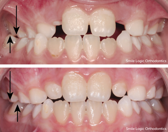 Crossbite before and after expander