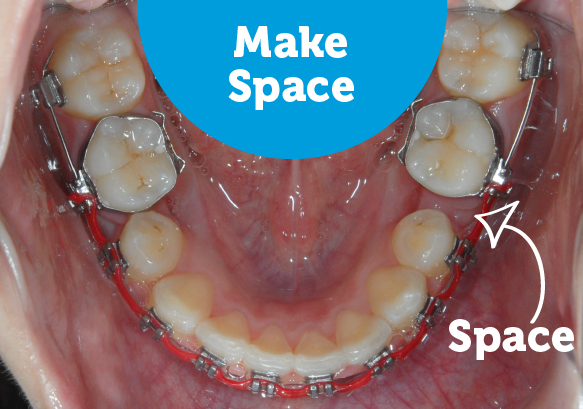 During braces make space for crooked teeth.