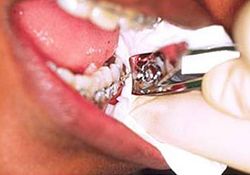 How to cut a wire poking from braces