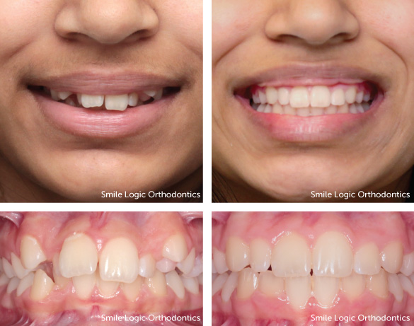 Deep bite before and after braces