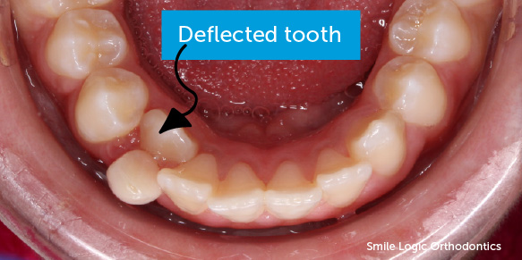 Deflected lower tooth