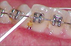 Remove food stuck in braces