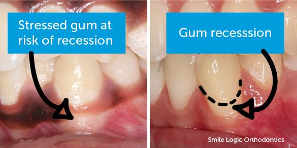 Before recession and after recession