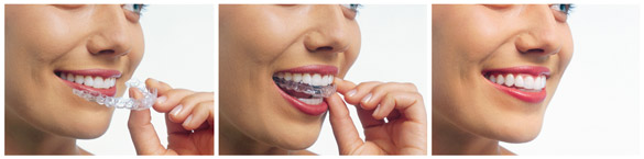 Clear aligners aligners are removable