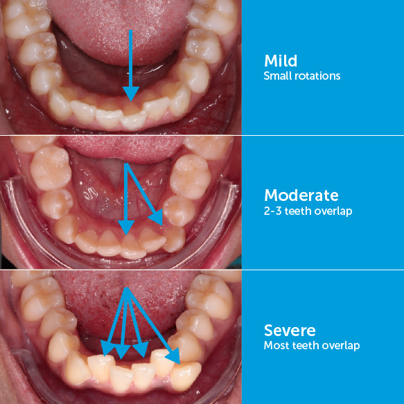 Mild crowding, moderate crowding, and severe crowding of the bottom front teeth.