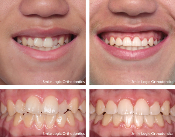 Mild crowding before and after braces