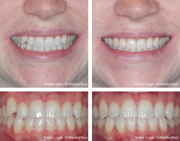 Mild crowding before and after clear aligners