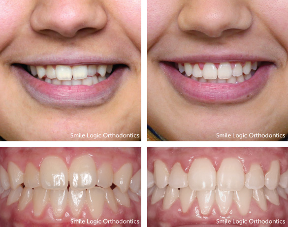 Mild crowding before and after braces