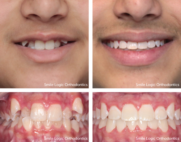 Moderate crowding before and after braces