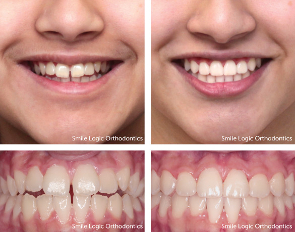 Open bite before and after braces