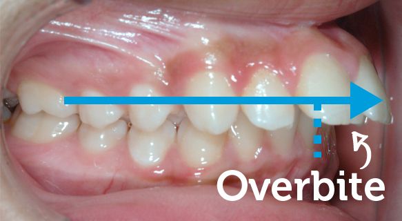 Overbite Corrected With Braces South Brunswick NJ