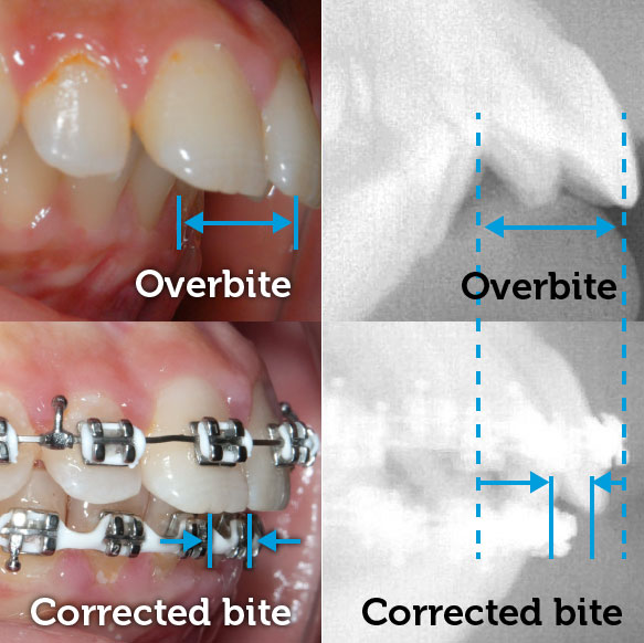 Overbite before braces