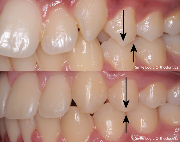 Overbite before and after braces