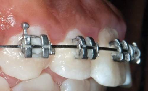 Plaque around braces