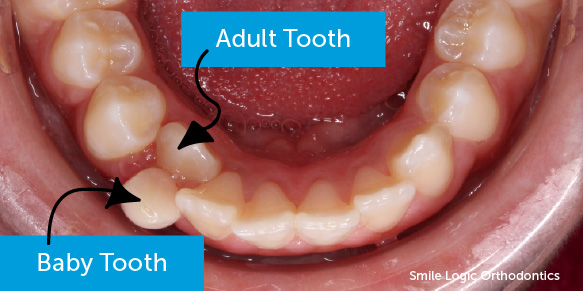 Big front teeth cause crowding.