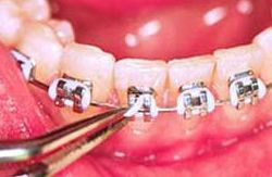 Replace braces colors