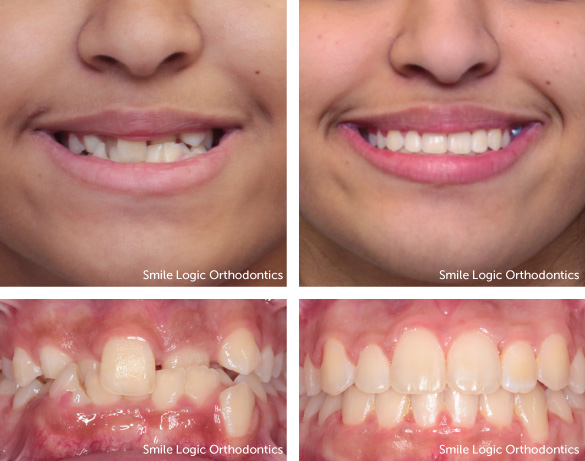 Severe crowding before and after braces and expander