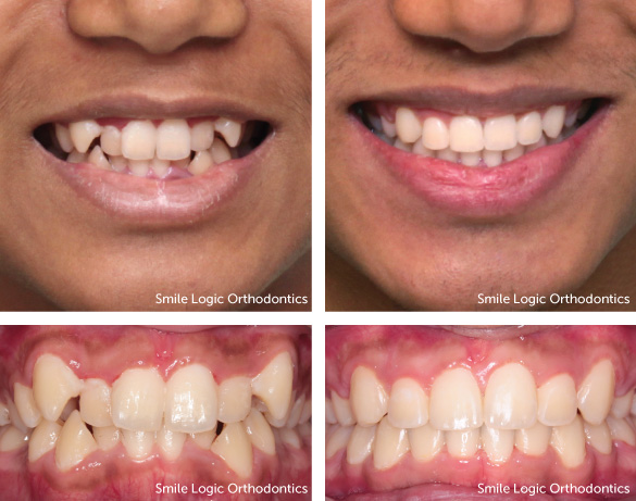 Severe crowding before and after braces