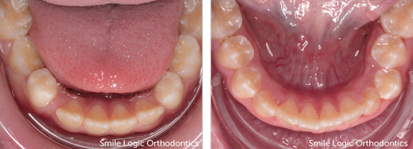 Severe crowding before and after space maintainer