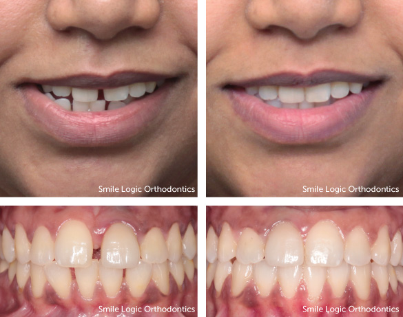 Spacing before and after clear aligners