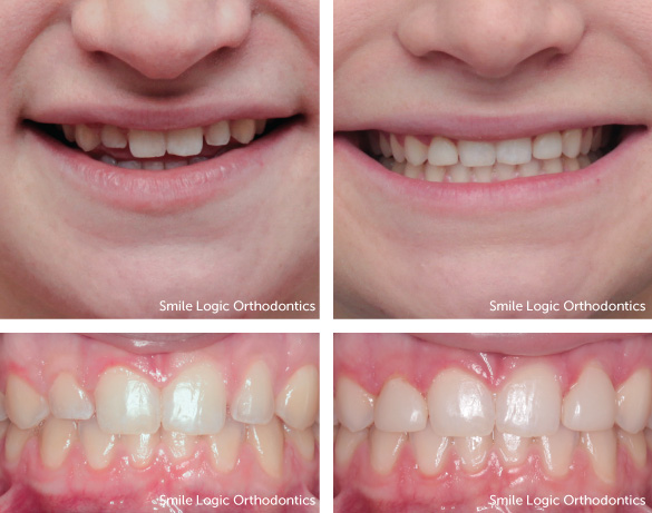 Spacing before and after veneers