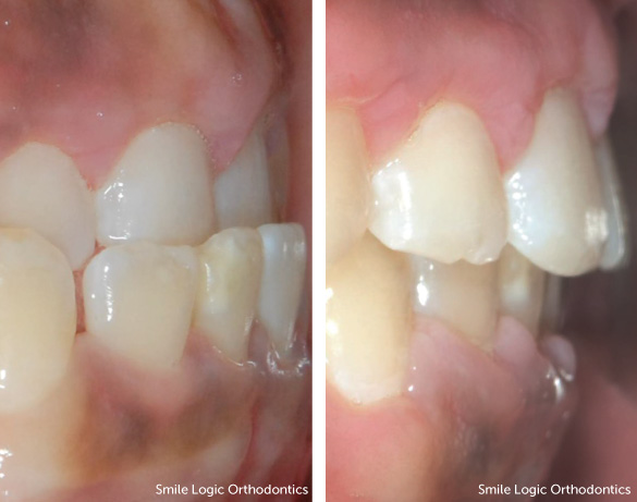 Underbite before and after braces